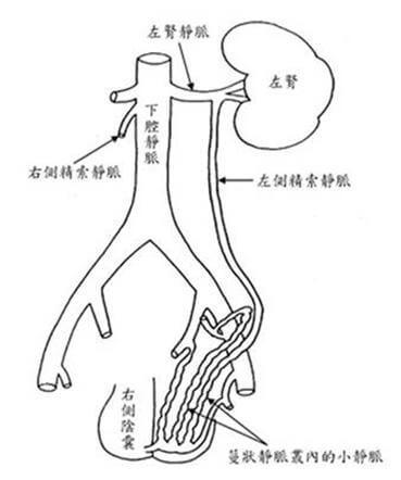 “精索靜脈曲張的原因”width=302