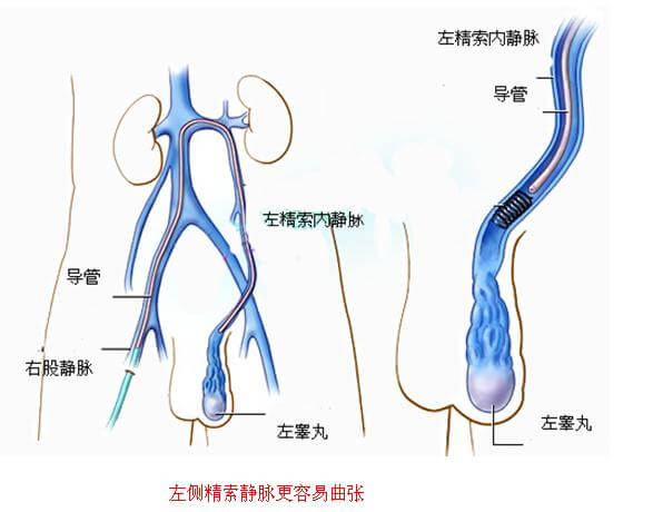 精索靜脈曲張手術(shù)費(fèi)用